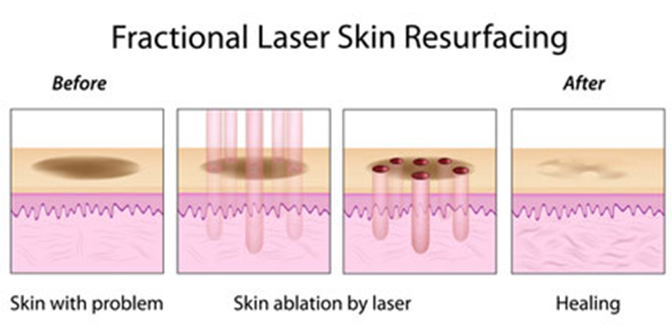 Fractional Laser Skin Resurfacing